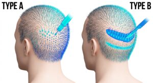 Comparison diagram showing FUE and FUT harvesting techniques